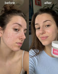 Патчі для обличчя проти недосконалостей Kormesic Anti-Acne Pads – азелаїнова або гліколева кислота, 50 шт.