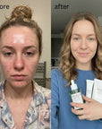 Zestaw do pielęgnacji skóry problematycznej SKIN1004 Tea-Trica 3w1 – serum 100 ml + krem punktowy 20 ml + krem kojący 75 ml