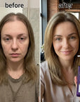 Roztwór do skóry głowy Kormesic 5% Minoxidil – wsparcie wzrostu i gęstości włosów