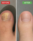 Патчі для нігтів при грибку Kormesic Daily Care Fungal Nail – 32 шт.