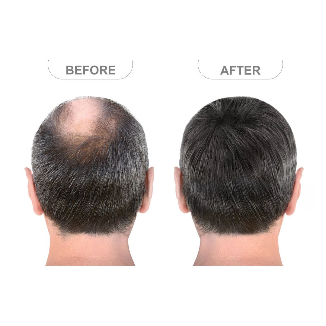 Zestaw przeciw wypadaniu włosów z minoksydylem 5% Kormesic (szampon + maska + serum)