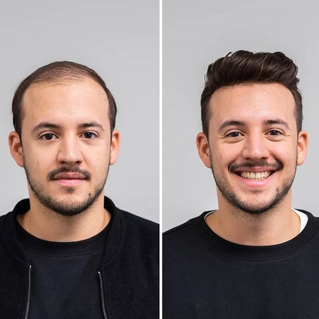 Zestaw przeciw wypadaniu włosów z minoksydylem 5% Kormesic (szampon + maska + serum)