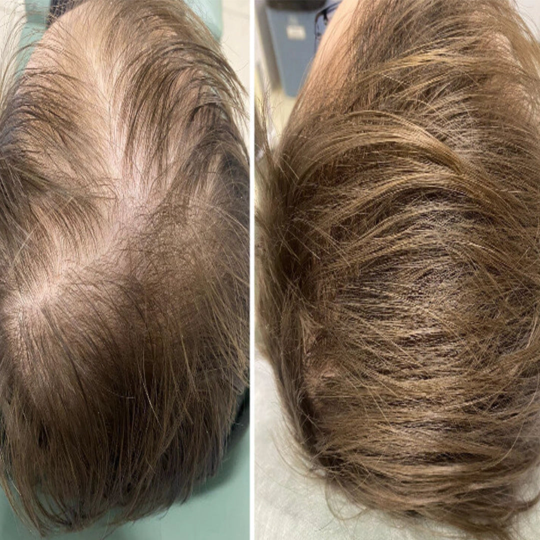 Zestaw przeciw wypadaniu włosów z minoksydylem 5% Kormesic (szampon + maska + serum)