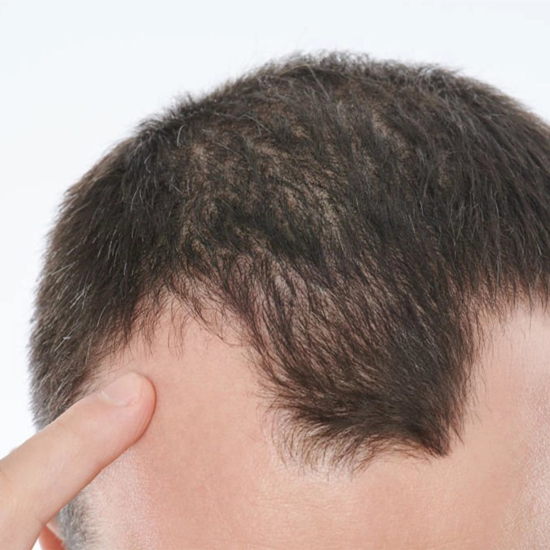 Zestaw przeciw wypadaniu włosów z minoksydylem 5% Kormesic (szampon + maska + serum)