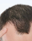 Zestaw przeciw wypadaniu włosów z minoksydylem 5% Kormesic (szampon + maska + serum)