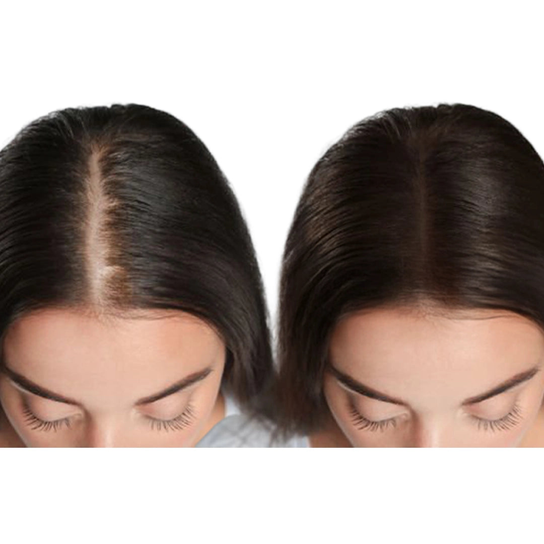 Zestaw przeciw wypadaniu włosów z minoksydylem 5% Kormesic (szampon + maska + serum)