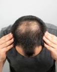 Zestaw przeciw wypadaniu włosów z minoksydylem 5% Kormesic (szampon + maska + serum)