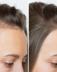 Zestaw przeciw wypadaniu włosów z minoksydylem 5% Kormesic (szampon + maska + serum)