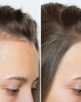 Zestaw przeciw wypadaniu włosów z minoksydylem 5% Kormesic (szampon + maska + serum)