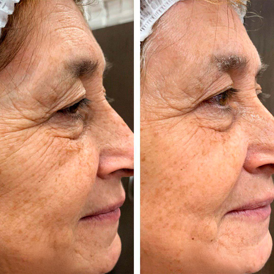 Serum z efektem botoksu do wygładzania zmarszczek i ujędrniania skóry — Botox Collagen Anti-Wrinkle Serum Kormesic (30 ml)