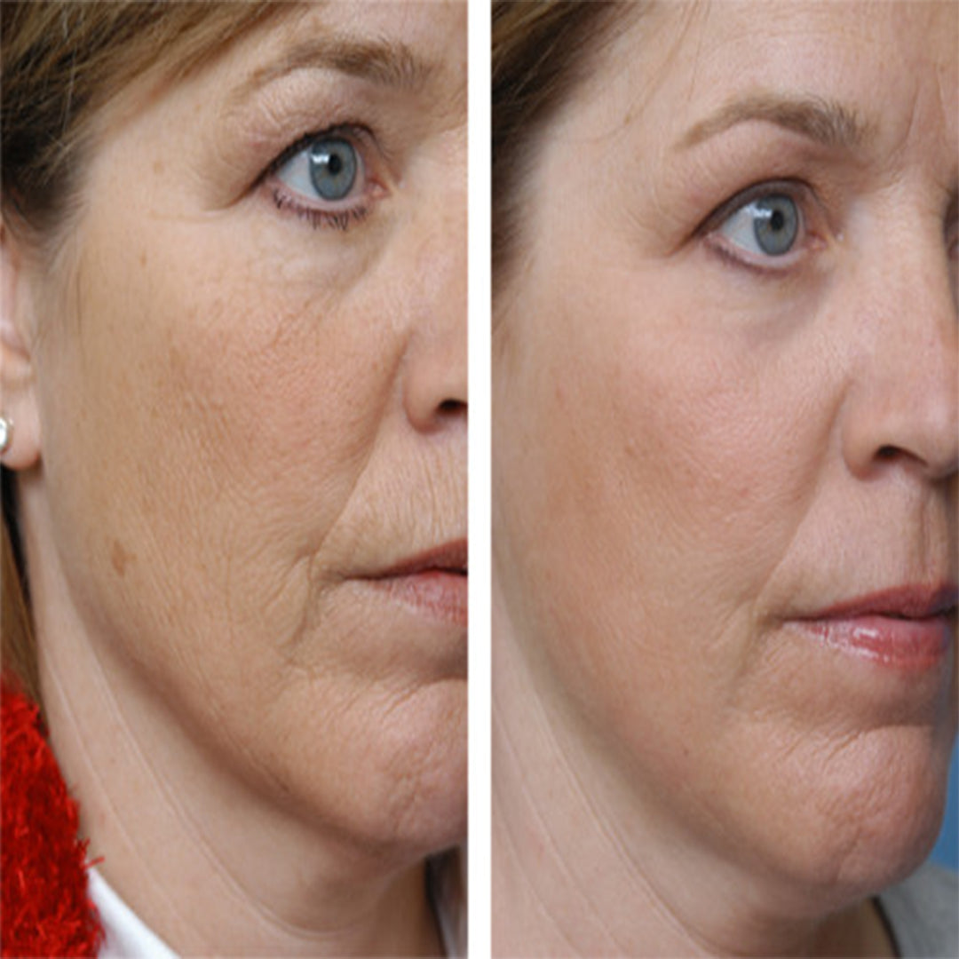 Serum z efektem botoksu do wygładzania zmarszczek i ujędrniania skóry — Botox Collagen Anti-Wrinkle Serum Kormesic (30 ml)