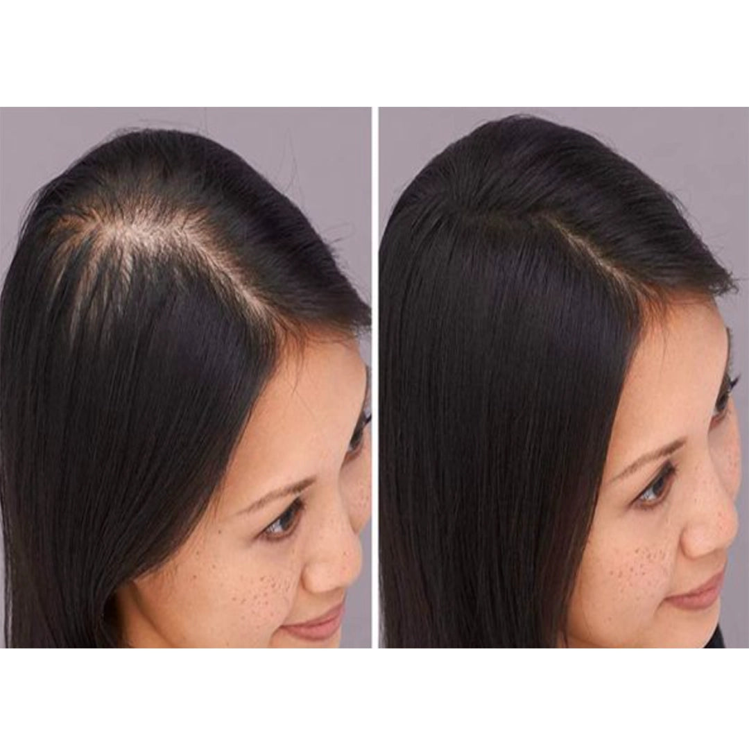 Zestaw przeciw wypadaniu włosów z minoksydylem 5% Kormesic (szampon + maska + serum)