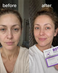 Zestaw przeciwzmarszczkowy do twarzy w ampułkach liofilizowanych – Botox Collagen 5 + 5 szt.