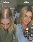 Zestaw KORMESIC Minoxidil 5% – kapsułki i ampułki - Zestawy do włosów