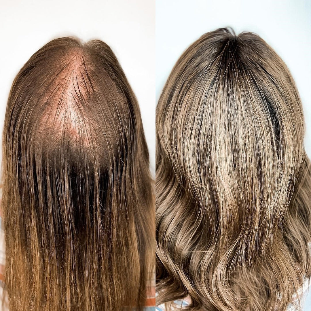 Zestaw przeciw wypadaniu włosów z minoksydylem 5% Kormesic (szampon + maska + serum)