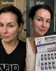 Sada ampulí proti vráskám na obličej v lyofilizované formě – Botoks Collagen 5 + 5 ks