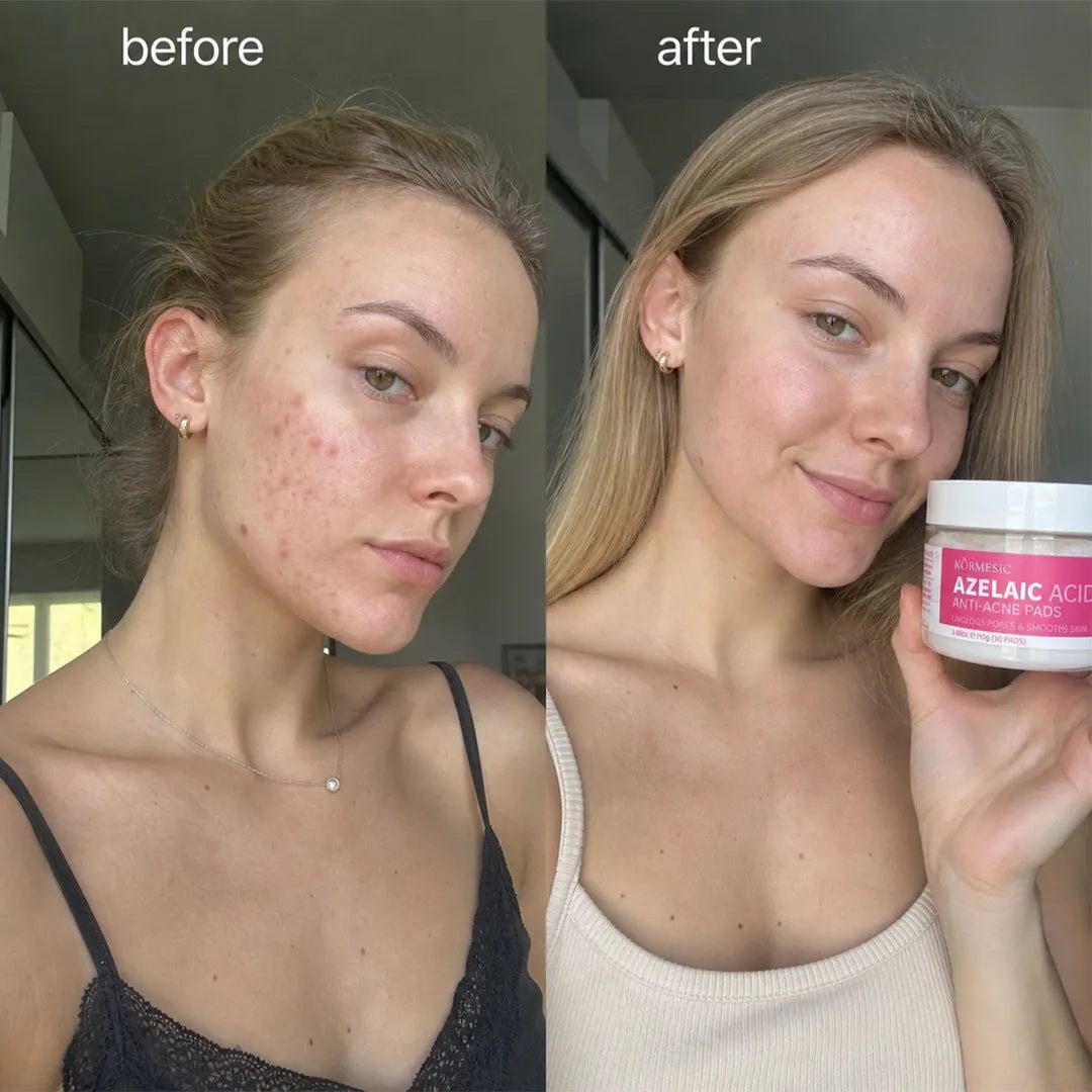 Sejas spilventiņi pret nepilnībām Kormesic Anti-Acne Pads – ar azelainskābi vai glikola skābi, 50 gab.  