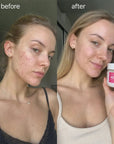Sejas spilventiņi pret nepilnībām Kormesic Anti-Acne Pads – ar azelainskābi vai glikola skābi, 50 gab.  