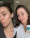Sejas spilventiņi pret nepilnībām Kormesic Anti-Acne Pads – ar azelainskābi vai glikola skābi, 50 gab.  