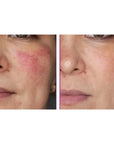 Krem-serum przeciwsłoneczne SPF 50+ PA++++ na zaczerwienienia – Mediheal
