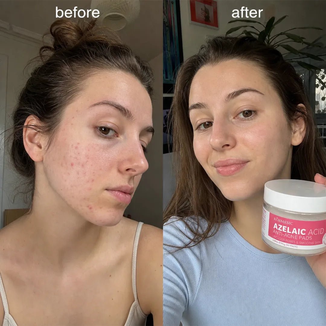 Sejas spilventiņi pret nepilnībām Kormesic Anti-Acne Pads – ar azelainskābi vai glikola skābi, 50 gab.  
