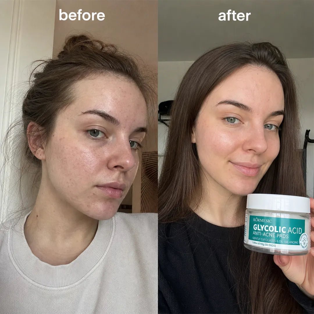 Sejas spilventiņi pret nepilnībām Kormesic Anti-Acne Pads – ar azelainskābi vai glikola skābi, 50 gab.  