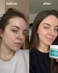 Sejas spilventiņi pret nepilnībām Kormesic Anti-Acne Pads – ar azelainskābi vai glikola skābi, 50 gab.  