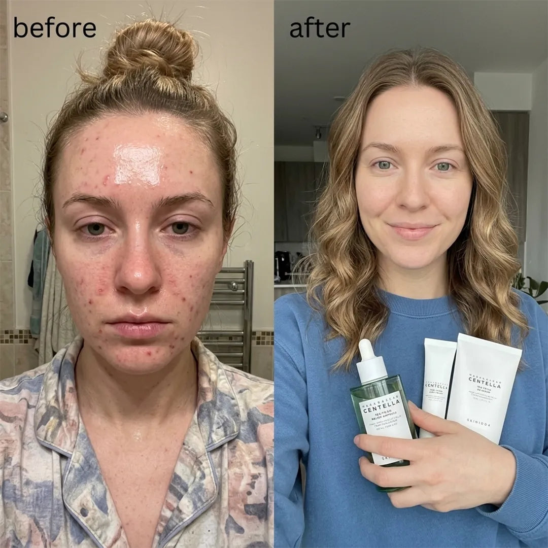 Zestaw do pielęgnacji skóry problematycznej SKIN1004 Tea-Trica 3w1 – serum 100 ml + krem punktowy 20 ml + krem kojący 75 ml