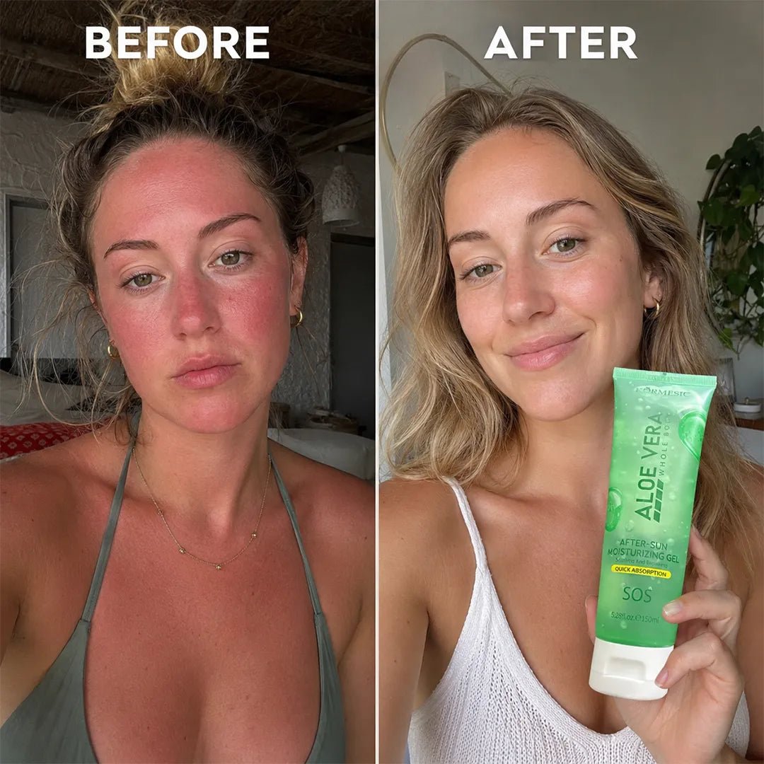 Żel po opalaniu Kormesic Aloe Vera – szybkie ukojenie, nawilżenie i regeneracja skóry po słońcu, 150 ml