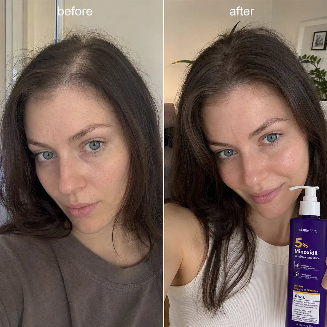 Roztwór do skóry głowy Kormesic 5% Minoxidil – wsparcie wzrostu i gęstości włosów