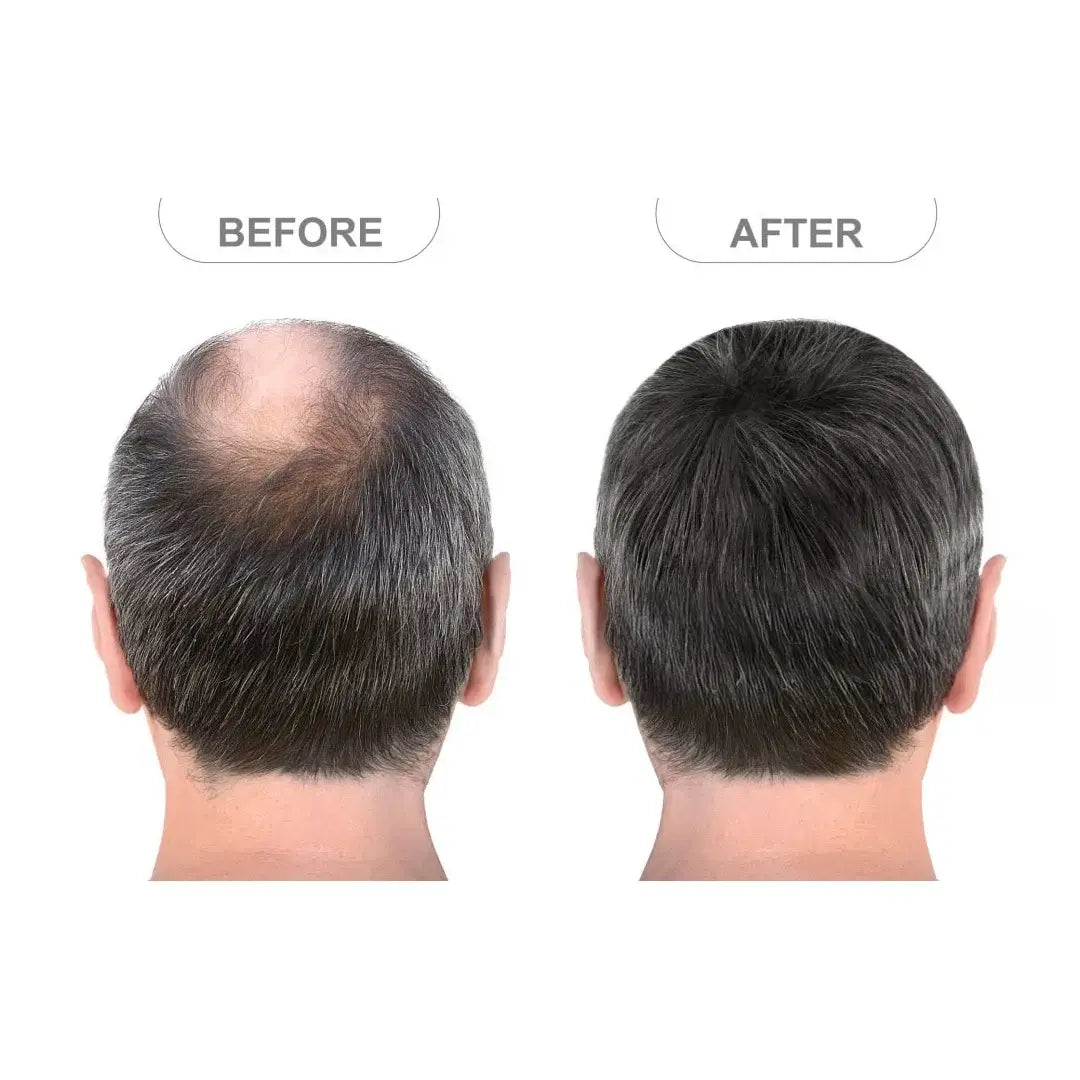 Zestaw przeciw wypadaniu włosów z minoksydylem 5% Kormesic (szampon + maska + serum)