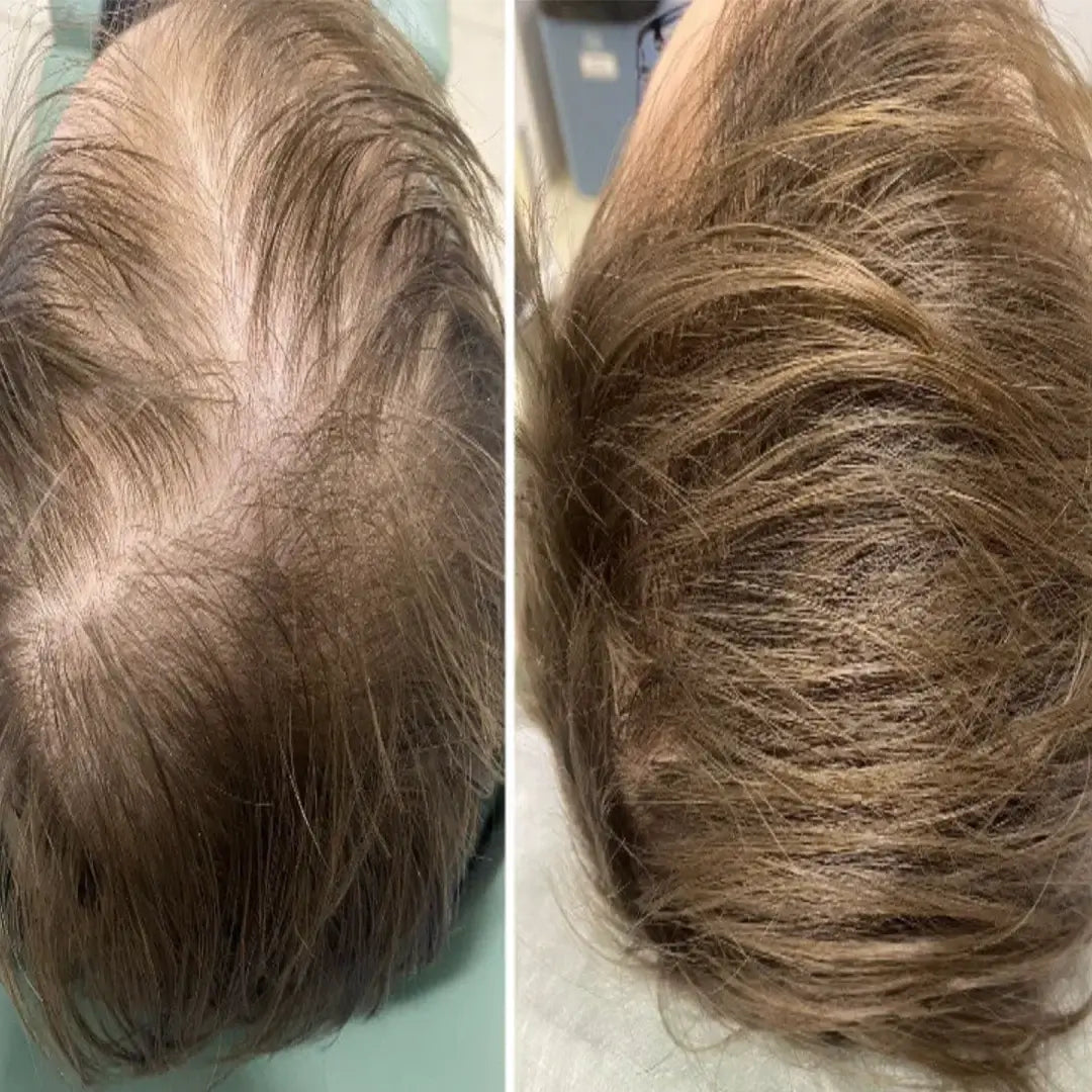 Zestaw przeciw wypadaniu włosów z minoksydylem 5% Kormesic (szampon + maska + serum)