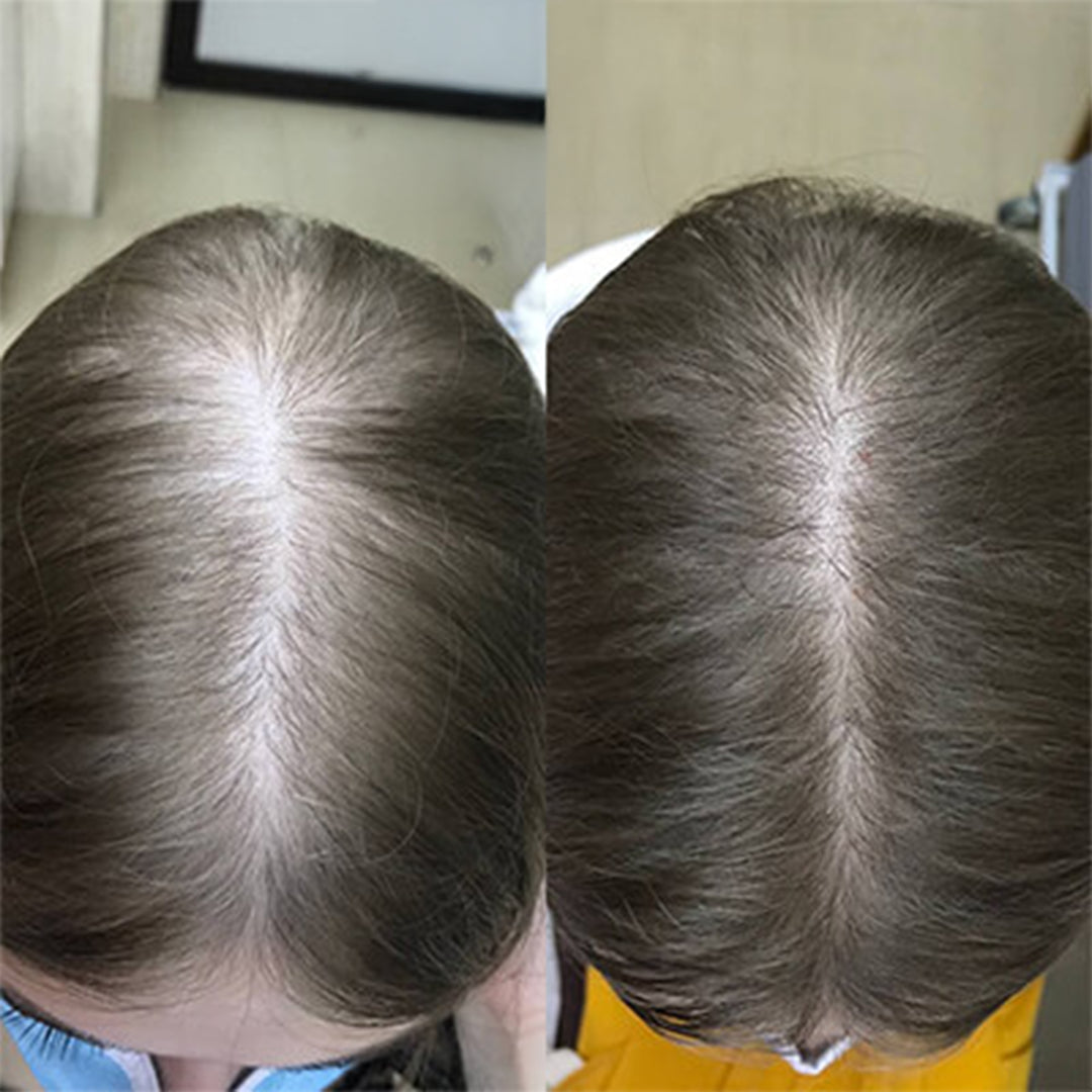 Oczyszczająca pianka do skóry głowy z 5% minoksydylem i biotyną – Kormesic, 150 ml