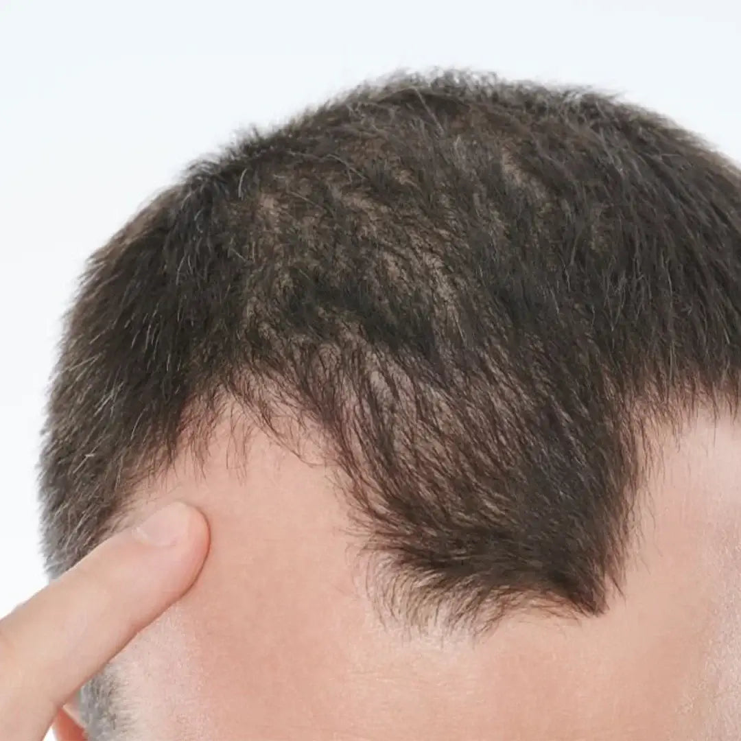 Zestaw przeciw wypadaniu włosów z minoksydylem 5% Kormesic (szampon + maska + serum)