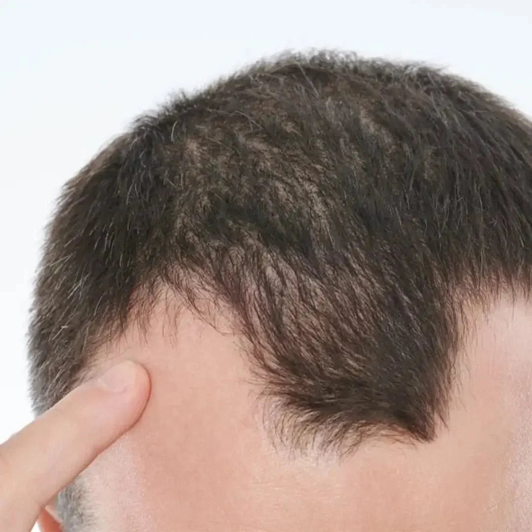 Zestaw przeciw wypadaniu włosów z minoksydylem 5% Kormesic (szampon + maska + serum)
