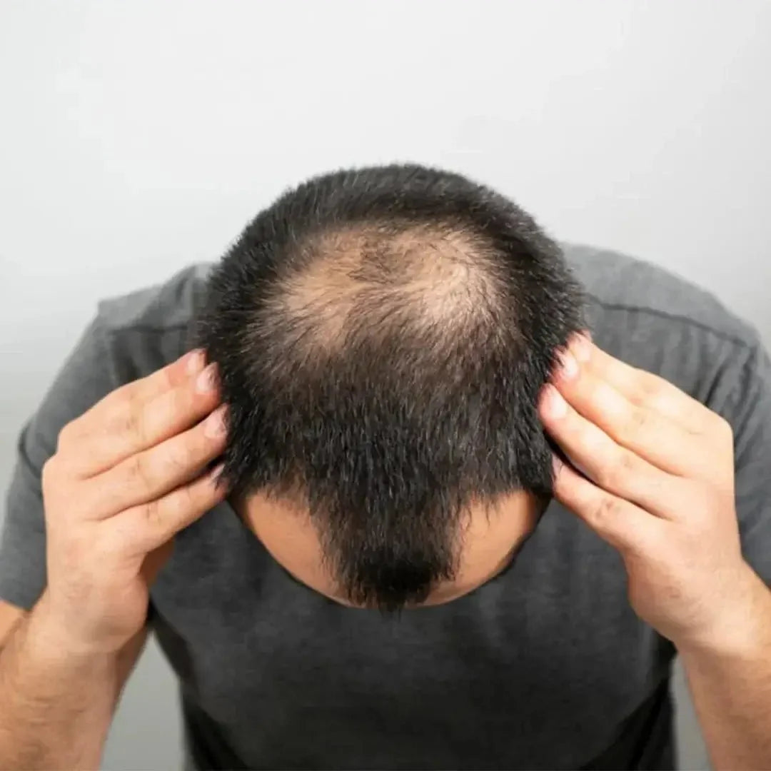 Zestaw przeciw wypadaniu włosów z minoksydylem 5% Kormesic (szampon + maska + serum)