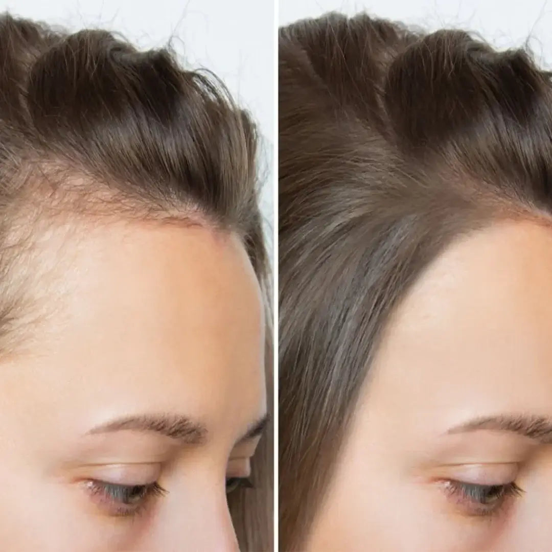 Zestaw przeciw wypadaniu włosów z minoksydylem 5% Kormesic (szampon + maska + serum)