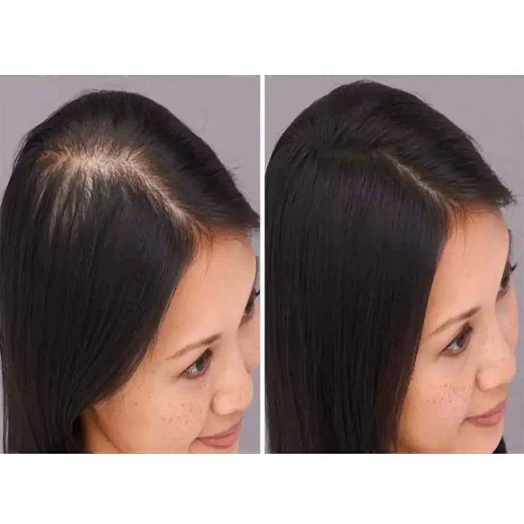 Zestaw przeciw wypadaniu włosów z minoksydylem 5% Kormesic (szampon + maska + serum)