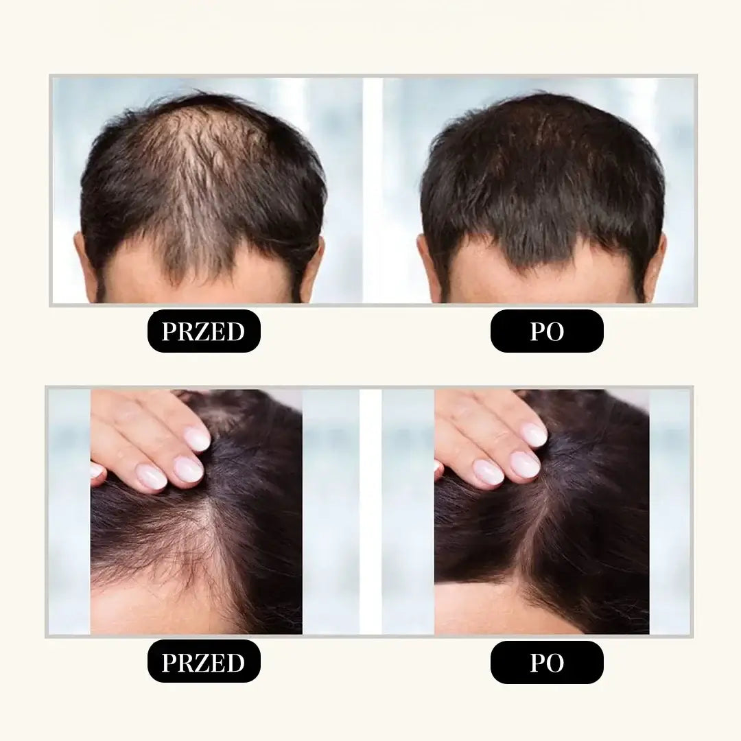 Zestaw przeciw wypadaniu włosów z minoksydylem 5% Kormesic (szampon + maska + serum)