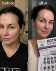 Zestaw przeciwzmarszczkowy do twarzy w ampułkach liofilizowanych – Botox Collagen 5 + 5 szt.