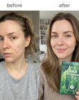 Plastry hydrokoloidowe na wypryski SKIN1004 – 22 sztuki