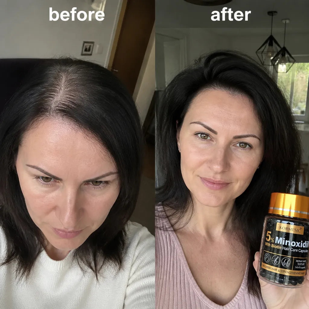 KORMESIC Minoxidil 5% kapsułki do pielęgnacji włosów z biotyną serum na porost włosów 15 ml - Kapsułki do włosów
