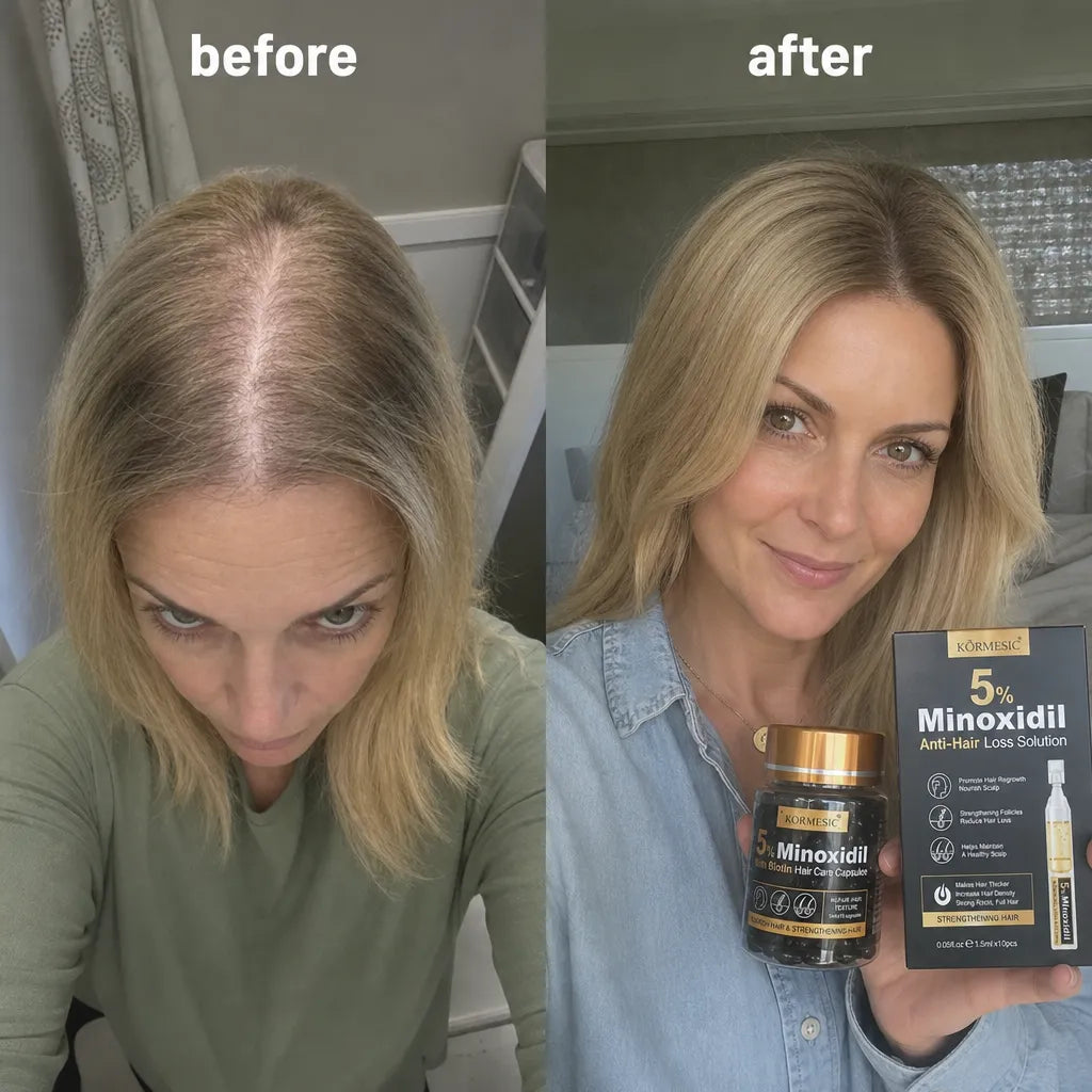 Sada KORMESIC Minoxidil 5 % – kapsle a ampule