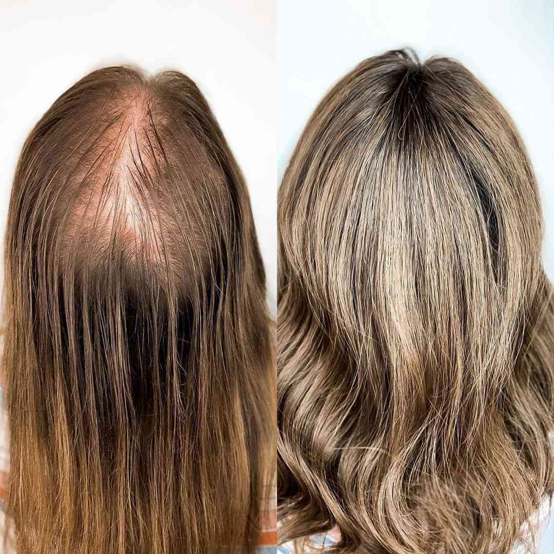 Serum z 5% Minoksydylem i Biotyną – intensywna kuracja przeciw wypadaniu włosów